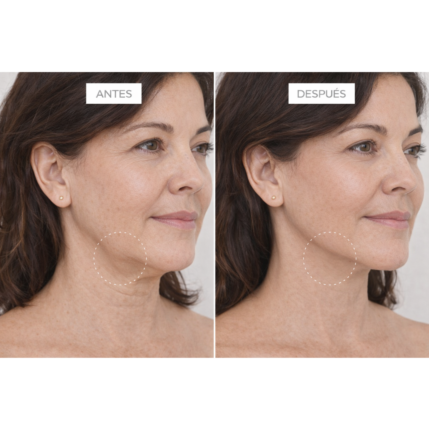 Clinical Exosomes: V-LIFTING EN 8 SEMANAS