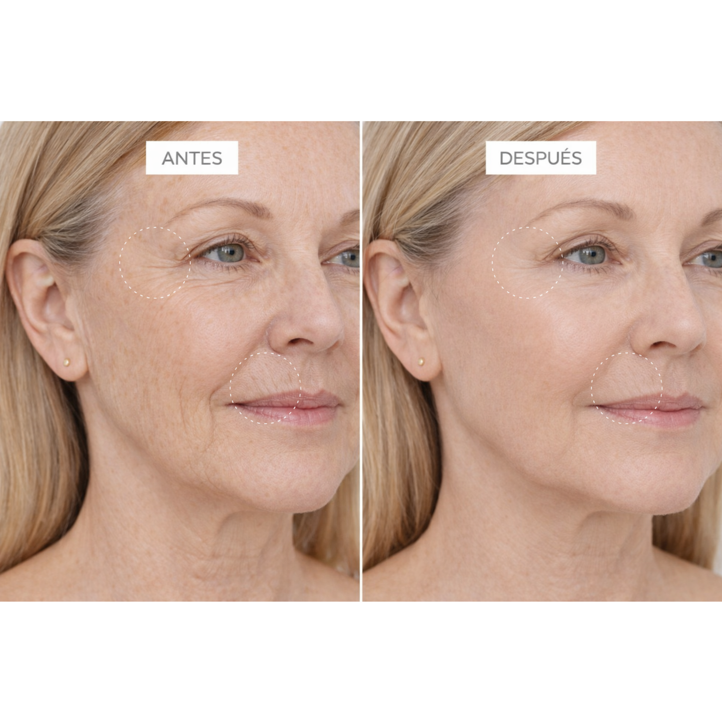 Clinical Exosomes: V-LIFTING EN 8 SEMANAS