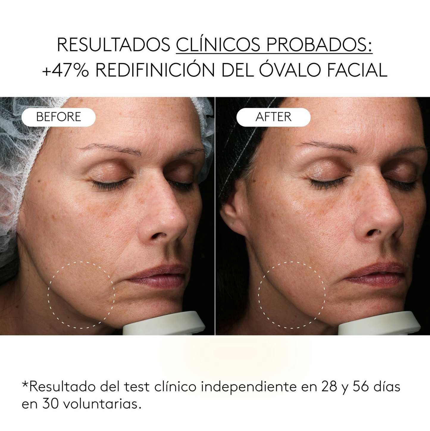 Clinical Exosomes: V-LIFTING EN 8 SEMANAS